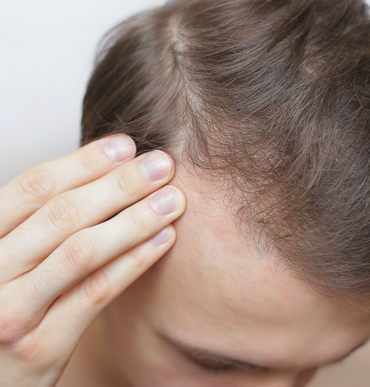 Man showing hair loss in his head