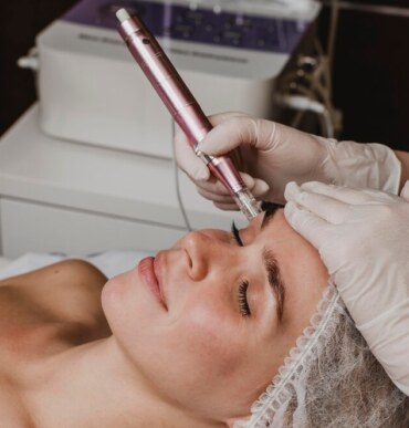 women undergoing potenza microneedling